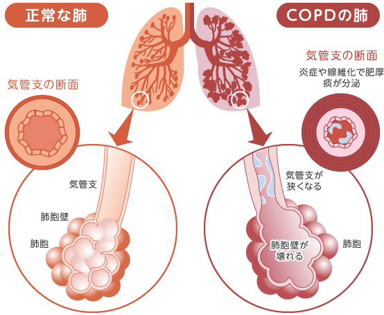 COPDの肺