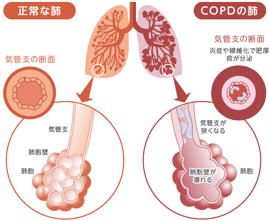 COPDと肺気腫の原因