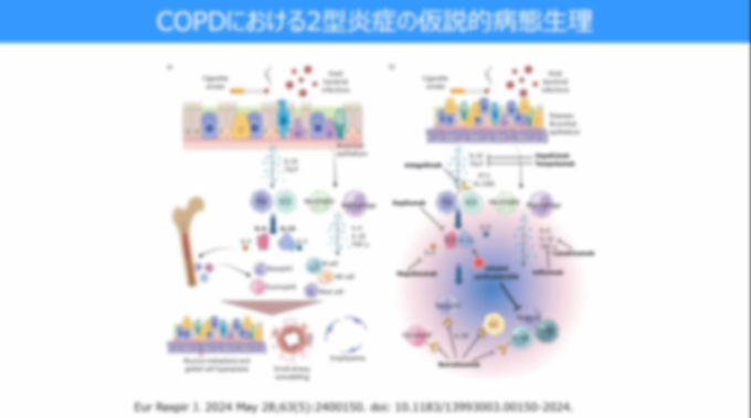 COPD治療の進化と増悪抑制：気管支拡張薬から生物学的製剤まで
